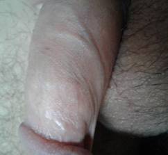 Vena dorsal del pene engrosada