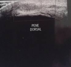 Trombo en vena dorsal del pene