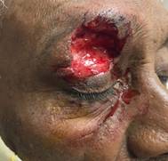 Herida avulsiva en la regi&oacute;n supraciliar derecha 