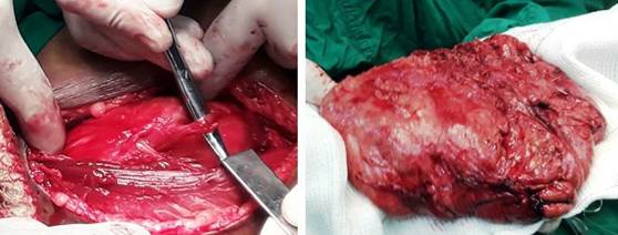 Imagen macrosc&oacute;pica del hibernoma