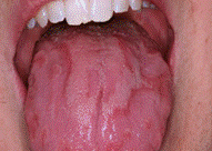 Papilitis lingual transitoria anterior en forma de U asociada