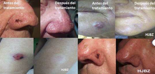 Ejemplos de pacientes antes y después de la aplicación del HeberFERON®