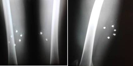 Im&aacute;genes de los proyectiles en ambos muslos