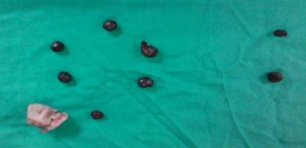 Proyectiles extra&iacute;dos junto al concentrador