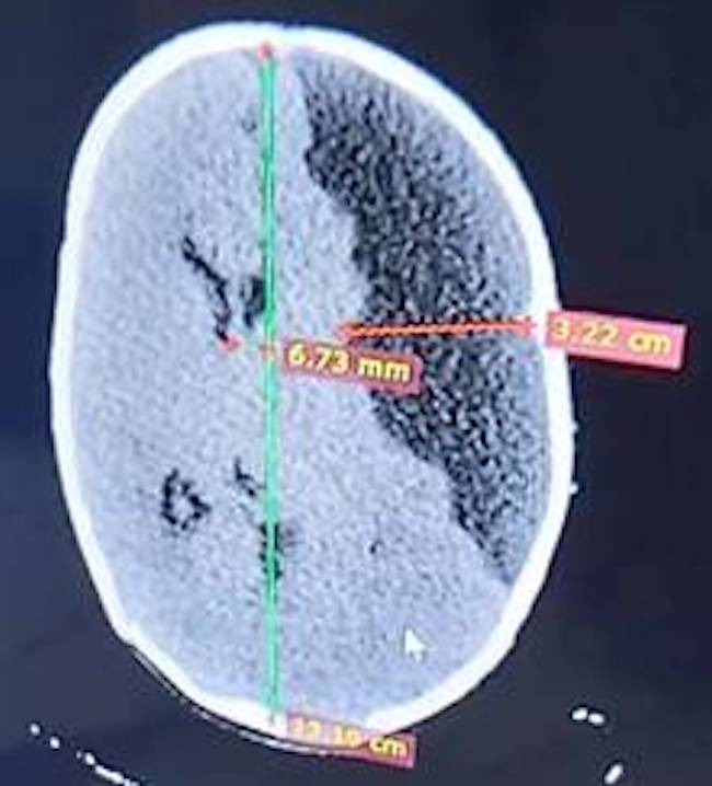 TAC de cráneo simple que muestra un higrohematoma subdural.