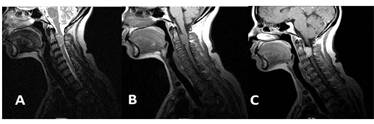 Meningioma cervical confirmado histol&oacute;gicamente: A) Isointenso en secuencia T2 sagital; B) Isointenso en secuencia T1 sagital; C) Captaci&oacute;n de contraste en secuencia T1 sagital