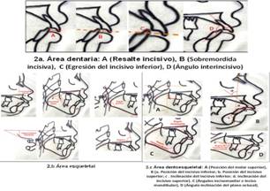 CefaloSan: an&aacute;lisis cefalom&eacute;trico dise&ntilde;ado para adolescentes santiagueros. &Aacute;reas I, II y II. 