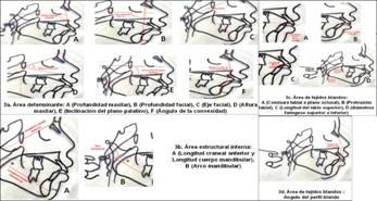 CefaloSan: an&aacute;lisis cefalom&eacute;trico dise&ntilde;ado para adolescentes santiagueros. &Aacute;reas IV, V y VI. 