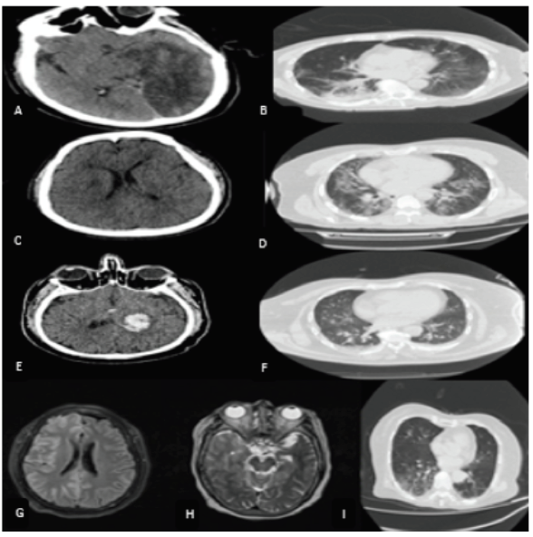 Figura 1. Infarto cerebral de vaso grande en región occipito temporal izquierda en paciente adulto mayor conneumonía por SARS-CoV-2 sin otro factor de riesgo vascular conocido (A,B). Infarto lacunar para ventricularderecho en paciente adulto joven con neumonía por SARS-CoV-2 sin factor de riesgo vascular conocido (C,D).Hemorragia intracerebral en ganglios basales izquierdos en paciente con neumonía por SARS-CoV-2 (E,F).RM de encéfalo con hiperseñal en FLAIR y T2, giriforme a nivel cortical y extensión a zonas subcorticales queafectan la región temporal, frontal y parietal derecha compatible con encefalitis en paciente con neumonía por SARS-CoV-2 (G,H,I).