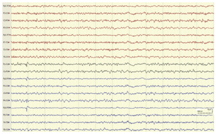 Figura 1. Actividad electroencefalogrfica compatible con una encefalopata de grado leve-moderado, caracterizada por una pobre diferenciacin topogrfica y constituida por ondas en rango theta con brotes de ondas delta, sin presentar criterios de status epilepticus mioclnico.