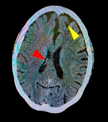 TEM de crneo sin contraste (13 horas antesde uci) corte axial.