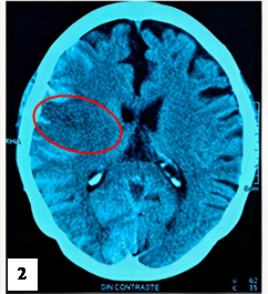 TEM cerebral sin contraste control (12 horas antes de UCI) de corte axial.