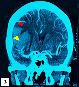 ANGIOTEM cerebral (da 2 de UCI). Cortecoronal.