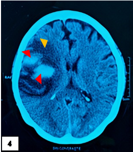 TEM cerebral sin contraste (da 13 de UCI). Corte axial.