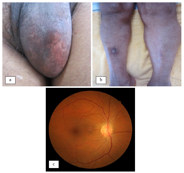 Lesiones cicatrzales en los escrotos (a), la cicatriz crnica del eritema nodoso (b) y el fondo de ojo con caractersticas normales (c)