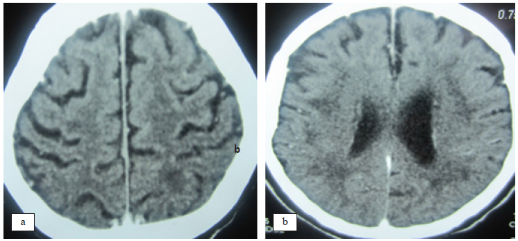 Hallazgos con estudio de TEM cerebral. El estudio mostr mltiples hipo- densidades en la sustancia blanca subcortical de localizacin frontoparietales a predominio izquierdo en los cortes axiales (a) y (b).