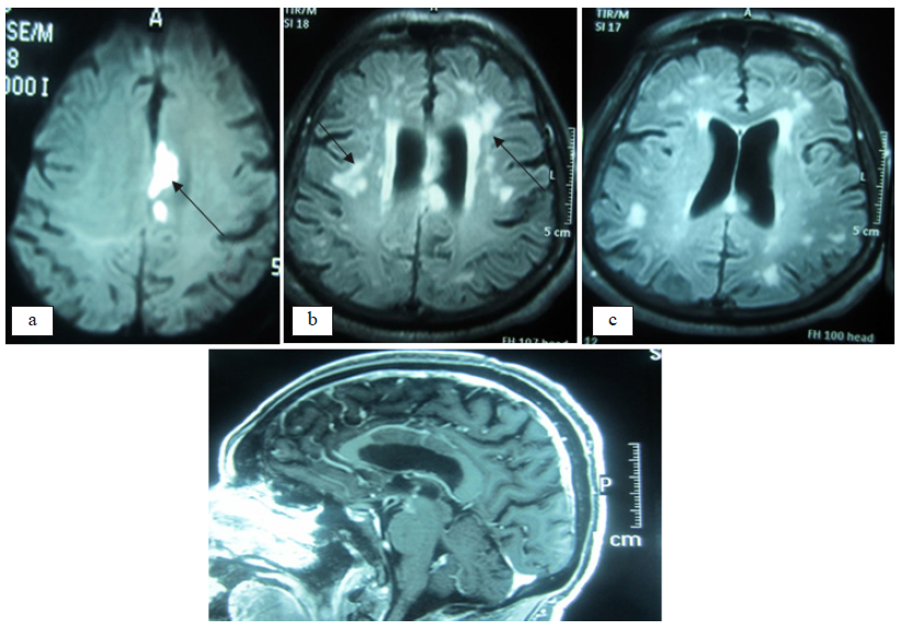 Investigacin con resonancia magntica cerebral. La investigacin con RM en FLAIR mostr mltiples focos hiperintensos a nivel frontal parasagital izquierdo (a), en la sustancia blanca subcortical temporal bilateral (b) y (c); en la secuencia T1 con contraste, la incidencia sagital muestra una seal hipointensa extensa en el cuerpo calloso sugerente de isquemia. Todos estos hallazgos son consistentes con enfermedad microvascular isqumica crnica.