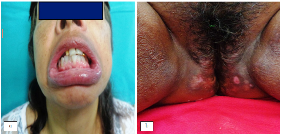 Presencia de aftas bucales (a) y vulvovaginales y glteos (b)