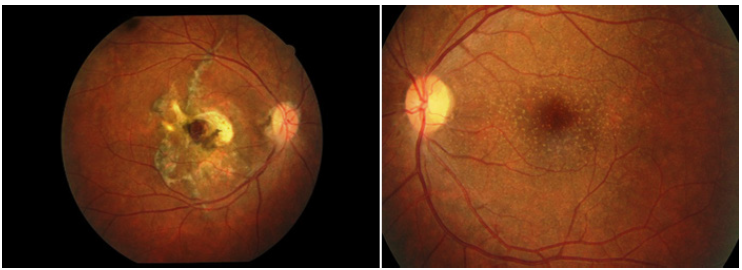 Fondo de ojo de la paciente en el que se observa gliosis atrfica macular y presencia de “drusas “peri maculares