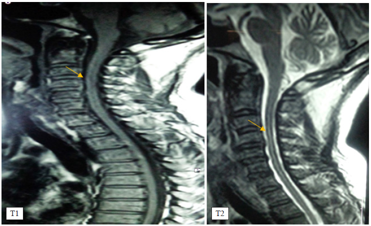 Resonancia magntica de la mdula espinal, corte sagital en secuencias T1 y T2 que muestra las seales de la isquemia filiforme cervicodorsal