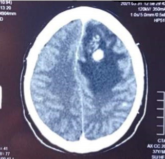Tomografa cerebral con contraste-corte axial. Lesin hipointensa a nivel frontal izquierdo con reas hiperintensas en su interior que capta contraste en anillo
