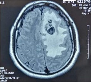 Resonancia magntica cerebral con contraste. Corte axial secuencia flair. Desplazamiento de la lnea media y compresin del ventrculo lateral izquierdo