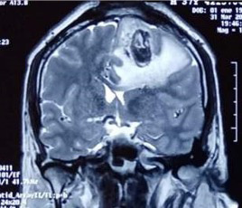 RMN con contraste. Corte coronal. Ausencia de fragmento seo frontoparietal y captacin de contraste en anillo