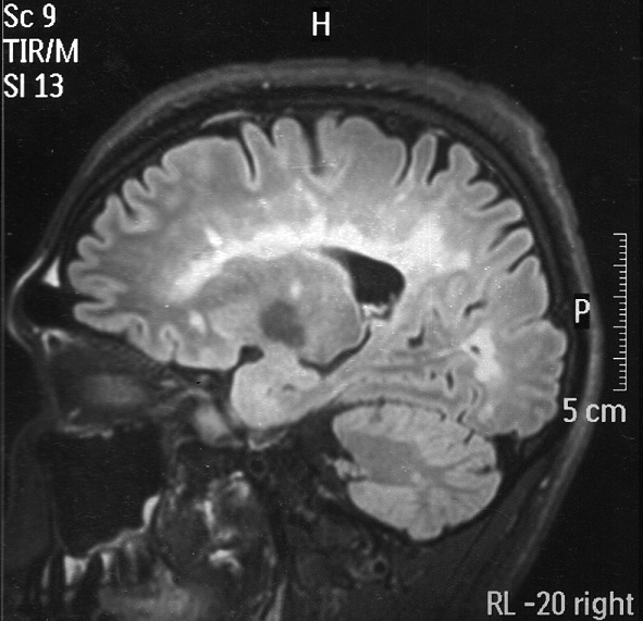 RM de encfalo FLAIR sagital, que muestra lesiones hiperintensas en el cuerpo calloso y lesiones yuxtacorticales