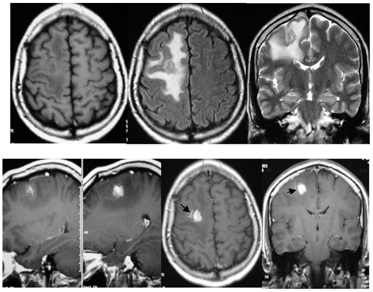 Resonancia magntica que grafica el vaso centinela a nivel frontal derecho
