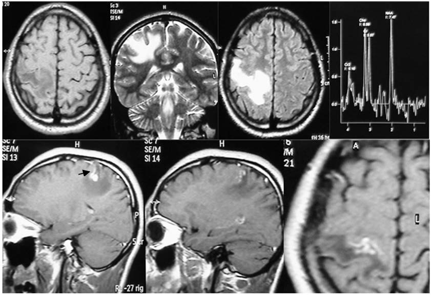 Resonancia magntica que grafica el vaso centinela a nivel fronto-parietal derecho