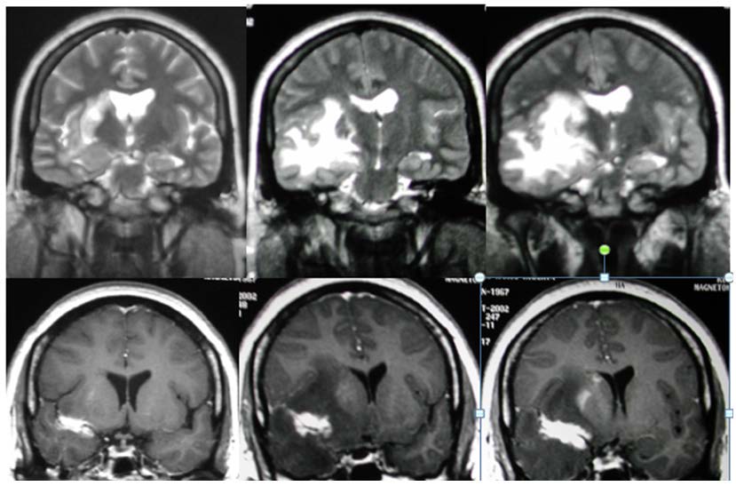 Resonancia magntica que grafica el vaso centinela a nivel fronto-temporal derecho