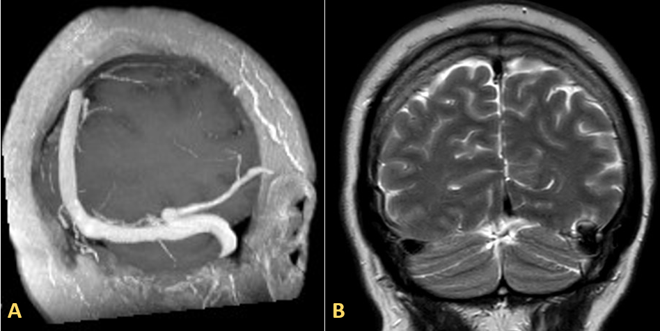 Magnetic resonance venography. A) Sequence 3D T1: The MIP reconstruction reveals a diverticulum situated at the junction of the vein of Labb� and the left transverse sinus, demonstrating permeability. B) Coronal T2 sequence: Mild hyperintensity in the adjacent temporal gyri.