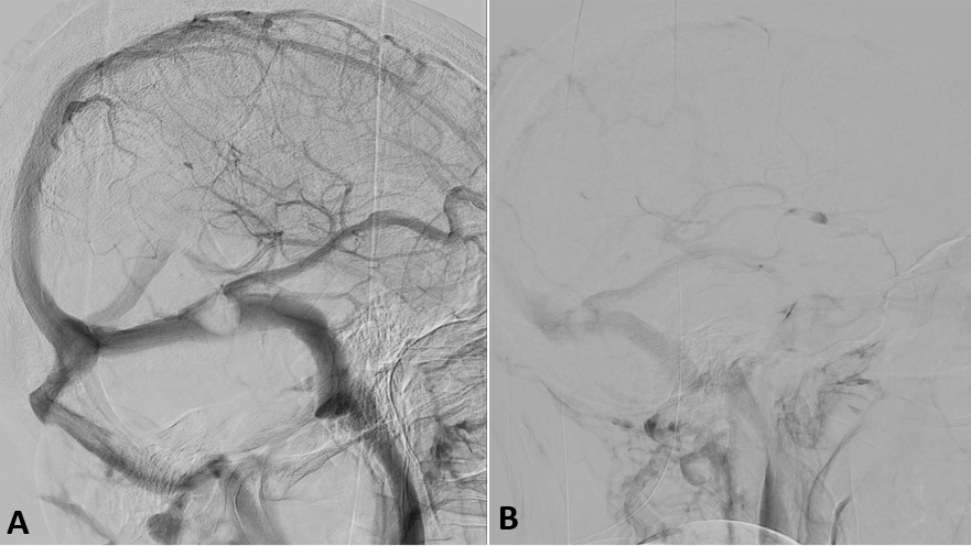 Cerebral angiography. A) Venous phase where a rounded repletion defect is observed in the left transverse sinus, at the level of the confluence with the vein of Labb�, which causes a significant stenosis. B) Late venous phase showing delayed washout of the vein of Labb�.