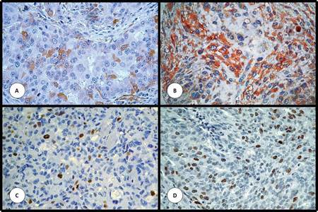 Expresión de proteínas estudiadas por inmunohistoquímica en matrices de tejidos. (A) aldehído deshidrogenasa 1 (aldh1). (B) CD10. (C) Ki-67 con índice proliferativo bajo. (D) Ki-67 con índice proliferativo alto. Aumento original de 200x.