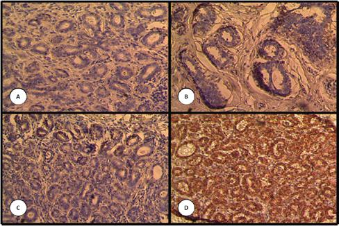 de BRCA1 estudiada por inmunohistoqu&iacute;mica en matrices de tejidos. Serie benigna: (A) negativo, n&uacute;cleo y citoplasma de c&eacute;lulas luminales. (B) positivo n&uacute;cleo de c&eacute;lulas mioepiteliales. (C) y (D) positivo n&uacute;cleo de c&eacute;lulas luminales. Aumento de 100x.