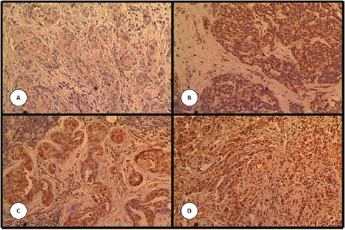 Expresi&oacute;n de BRCA1 estudiada por inmunohistoqu&iacute;mica en matrices de tejidos. Serie maligna: (A) negativo,n&uacute;cleo y citoplasma de c&eacute;lulas tumorales. (B) positivo n&uacute;cleo. (C) y (D) positivo n&uacute;cleo y citoplasma. Aumento de 100x.
