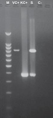 Detection of VIM type metallo-beta-lactamases and KPC type serin-carbapenemase by PCR in the strain of E. hormaechei subsp. hormaechei. Amplification of both fragments of 390 bp and 798 bp, typical of blaVIM and blaKPC can be seen in the studied isolate. M: molecular weight marker of 100 bp, VC+: positive control for blaVIM gene (E. cloacae amplified only with primers for blaVIM) (11), KC+: positive control for blaKPC gene (E. cloacae amplified only with primers for blaKPC) (11), S: studied isolate of E. hormaechei subsp. hormaechei, C-: negative control (water).