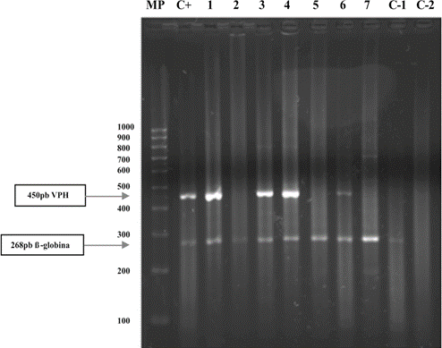 Visualizaci&oacute;n de la detecci&oacute;n de VPH mediante electroforesis en gel de agarosa al 2%; MP: Marcador de peso molecular (100 pb Invitrogen); C+: Control positivo (indicador a 450 pb) y control interno de la integridad del ADN (gen de β-globina a 268pb); 1, 3, 4, 6: Muestras de pacientes VPH positivas; 2, 5 y 7: Muestras de pacientes VPH negativos; C-1: Control negativo con ADN de paciente sano (se observa la banda de 268pbcorresponden al gen β-globina); C-2: Control negativo (solo mezcla de reacci&oacute;n).