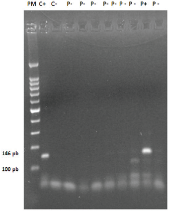 Gel de agarosa al 2%, muestra corrida del gen RAR&szlig;2, PM: marcador de peso molecular 100pb, C+: control positivo, C-: control negativo P+: paciente positivo, P-: paciente negativo.