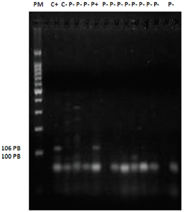 Gel de agarosa al 2%, muestra corrida del gen E-cadherin PM: marcador de peso molecular 100pb, C+: control positivo, C-: control negativo, P+: paciente positivo, P-: paciente negativo.