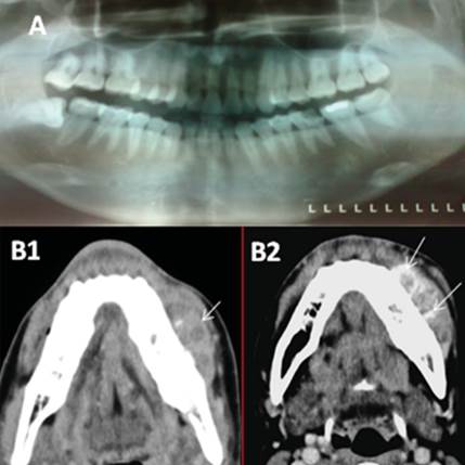 An&aacute;lisisimagenol&oacute;gicos. (A) Radiograf&iacute;a: 1er molar cariado, cambios de densidad m&iacute;nimos en regi&oacute;n molar. (B)TAC: lesi&oacute;n tumoral en tejidos blandos. (B-1) Con lesiones hipodensas en su interior. (B-2) Calcificaciones y m&iacute;nimos cambios en cortical.