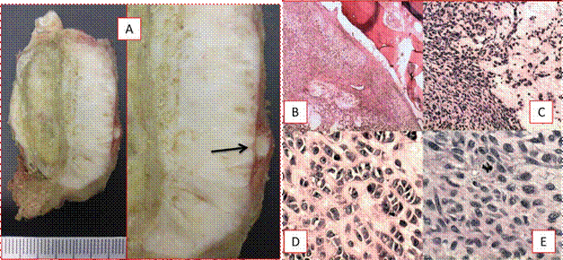 Examenmacrosc&oacute;pico e histopatol&oacute;gico. (A): Esp&eacute;cimen en corte coronal, tumor bien delimitado, infiltraci&oacute;n cortical y trombo vascular neopl&aacute;sico, (Flecha). Microfotografias: (B) Proliferaci&oacute;n neopl&aacute;sica periosteal con infiltraci&oacute;n cortical (4X). (C) Cambios mixoides y zona fusiforme (10X). (D) Focos de diferenciaci&oacute;n condroide maligna (10X). (E) Mitosis at&iacute;pica en c&eacute;lulas fusiformes (40X).