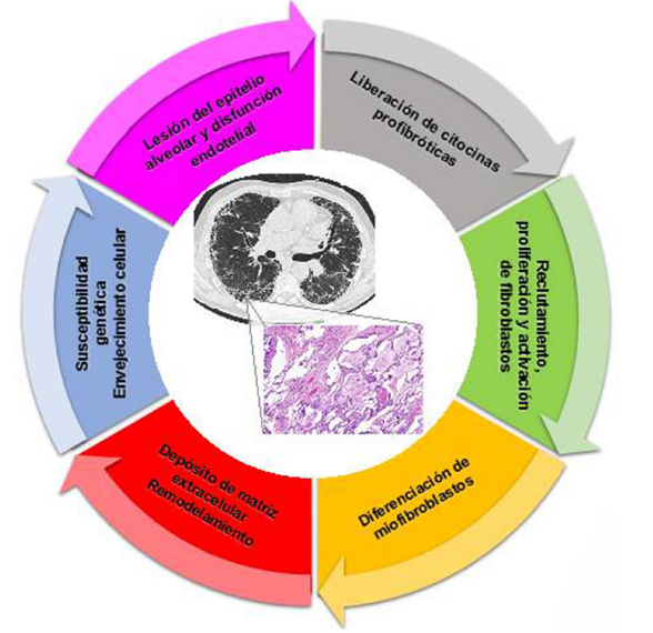 propuestos en la patogénesis de la fibrosis pulmonar idiopática. El humo del cigarrillo, los polvos industriales, el reflujo gastroesofágico o las infecciones virales pueden provocar la activación de las células epiteliales alveolares de individuos con susceptibilidad particular para desarrollar la fibrosis (por ejemplo, edad, genética), lo que produce una reparación aberrante y una acumulación excesiva de matriz extracelular.