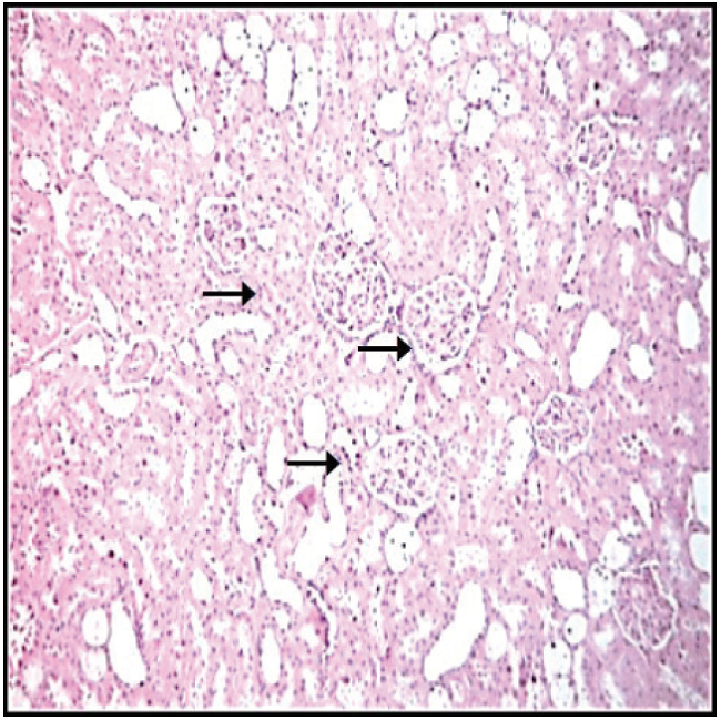 Microfotograf&iacute;a de corteza renal de animales diab&eacute;ticos tratados con soluci&oacute;n salina en la que se observan glom&eacute;rulos renales (flechas), que muestran espacios urinarios reducidos con cambios difusos, aumento de la matriz mesangial, paredes capilares engrosadas con luces colapsadas y adherencias a la c&aacute;psula de Bowman (250X, hematoxilina-eosina). 