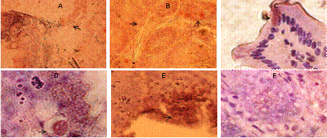 Inmunolocalizaci&oacute;n de VEGF en intestino de ratones BALB/c con 8 semanas de infecci&oacute;n y quince d&iacute;as post-tratamiento (A-E, flechas) y en ratones BALB/controles sanos (F con inmunotinci&oacute;n negativa. Barra A-C=50&micro;m y D-F=25&micro;m. 