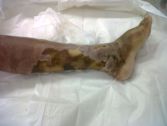 Extensive confluent ulcers involving two-thirds of the left leg