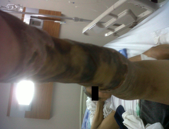 View of the calf region where the most extensive lesion is observed, covering 80% of the circumference of the left leg