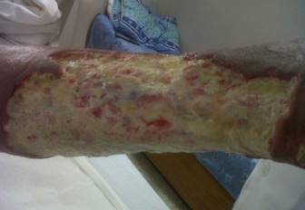 Status after Surgical Debridement. There is evidence of subcutaneous cellular tissue and muscle aponeurosis compromise in some points