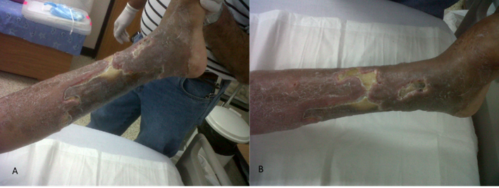 3 days after the start of treatment with topical betamethasone/gentamicin with a considerable reduction of perilesional edema