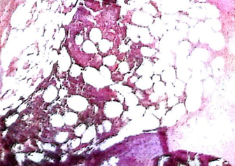 Inflammatory infiltration of polymorphonuclear and mononuclear cells, fibrosis and hyalinization of collagen and elastic fibers, basal cell hyperplasia and hyperkeratosis with mild acanthosis, compatible with classical pyoderma gangrenous